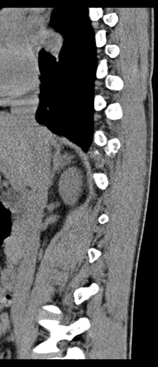 Aneurysmal bone cyst T11 (Radiopaedia 29294-29721 E 57).jpg