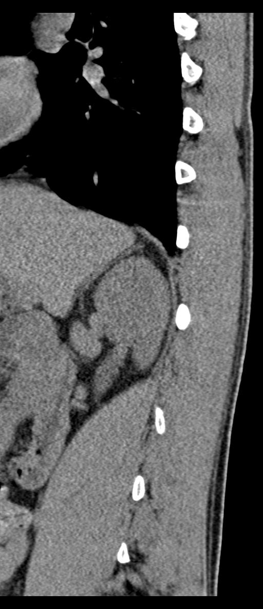 Aneurysmal bone cyst T11 (Radiopaedia 29294-29721 E 65).jpg