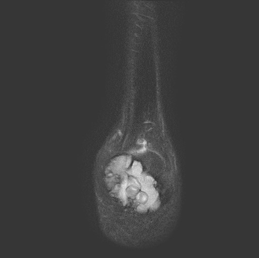 File:Aneurysmal bone cyst of the calcaneus (Radiopaedia 60669-68420 Coronal T2 fat sat 25).jpg