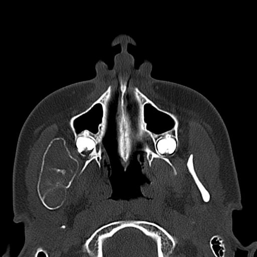 Aneurysmal bone cyst of the mandible (Radiopaedia 43280-46601 Axial bone window 58).jpg