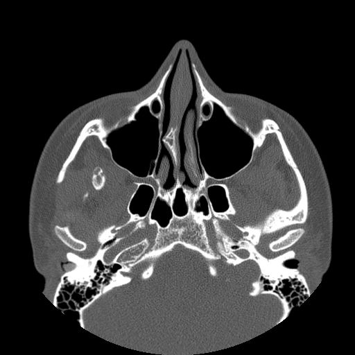 Aneurysmal bone cyst of the mandible (Radiopaedia 43280-46823 Axial bone window 140).jpg