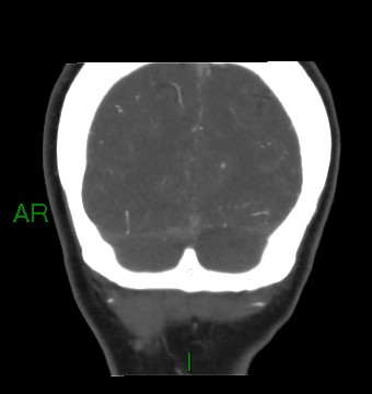 Aneurysmal subarachnoid hemorrhage with intra-axial extension (Radiopaedia 84371-99732 C 17).jpg