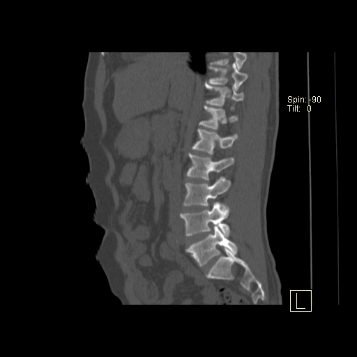 File:Ankylosing spondylitis (Radiopaedia 52728-58645 Sagittal bone window 15).jpg