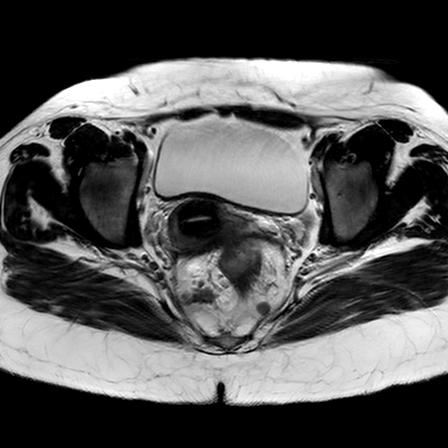File:Ano-vaginal fistula (Radiopaedia 29765-30284 Axial T2 16).jpg