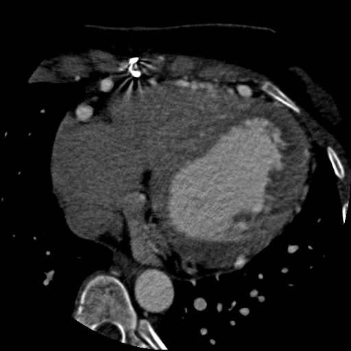 Anomalous left coronary artery from the pulmonary artery (ALCAPA) (Radiopaedia 40884-43586 A 56).jpg