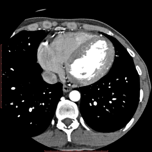 Anomalous left coronary artery from the pulmonary artery (ALCAPA) (Radiopaedia 70148-80181 A 271).jpg