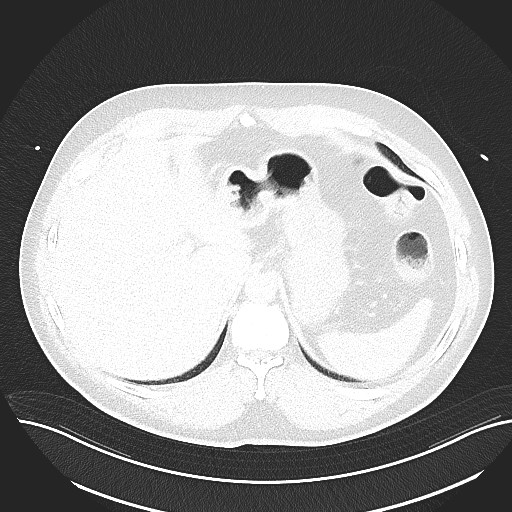 File:Anomalous origin of the left coronary artery with malignant course (Radiopaedia 77842-90126 Axial lung window 32).jpeg