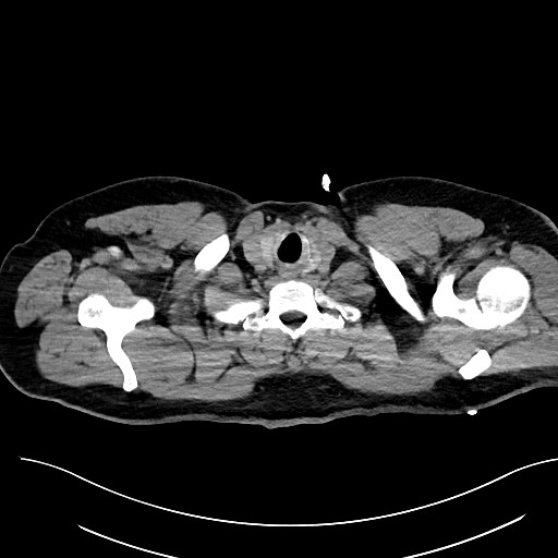File:Anomalous origin of the left coronary artery with malignant course (Radiopaedia 77842-90126 Axial non-contrast 1).jpeg