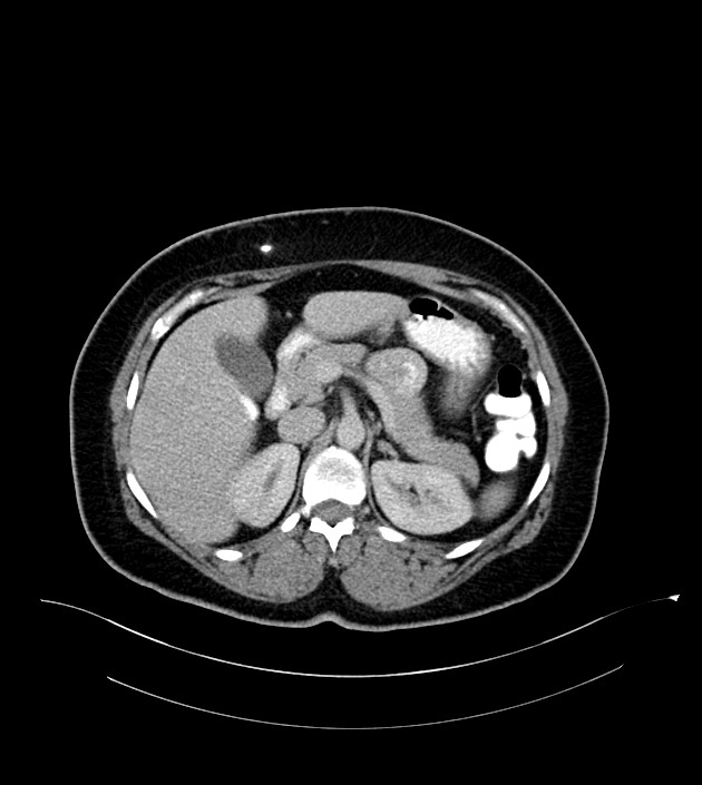 Anterior abdominal wall CSF pseudocyst (CSFoma) (Radiopaedia 79453-92571 A 32).jpg