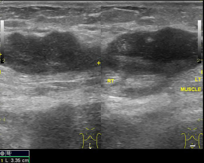 File:Anterior abdominal wall abscess - post LSCS (Radiopaedia 30343-30989 B 1).jpg