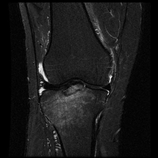 File:Anterior cruciate ligament avulsion fracture (Radiopaedia 58939-66193 Coronal STIR 9).jpg