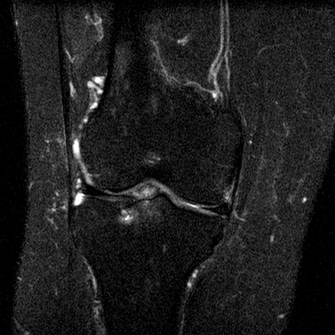 File:Anterior cruciate ligament mucoid degeneration (Radiopaedia 60853-68633 Coronal STIR 18).jpg