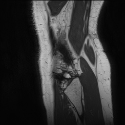 Anterior cruciate ligament rupture and posteromedial corner injury (Radiopaedia 67338-76723 Sagittal PD 151).jpg