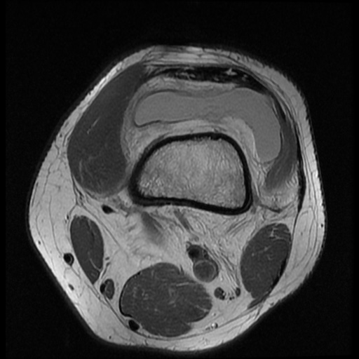 File:Anterior cruciate ligament tear (Radiopaedia 61500-69462 Axial PD 1).jpg