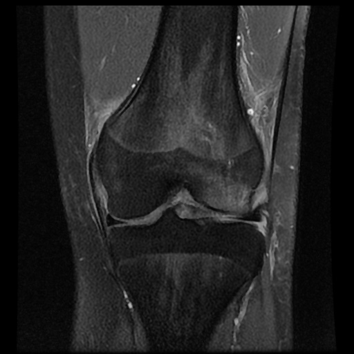 File:Anterior cruciate ligament tear (Radiopaedia 61500-69462 Coronal PD fat sat 11).jpg
