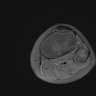 File:Anterior cruciate ligament tear - pediatric (Radiopaedia 62152-70260 Axial PD fat sat 35).jpg