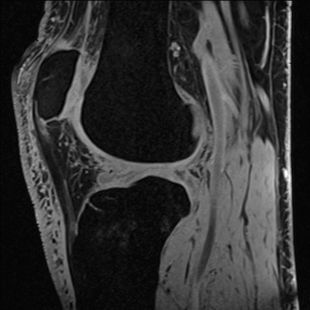 Anterior cruciate ligament tear - ramp lesion (Radiopaedia 71883-82322 Sagittal T1 vibe 59).jpg
