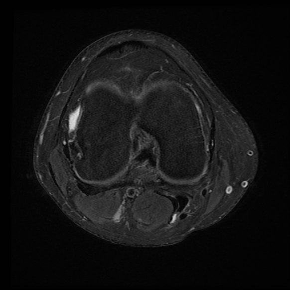 File:Anterior cruciate ligament tear with posteromedial corner injury, bucket-handle meniscal tear and chondral delamination (Radiopaedia 75501-86744 Axial PD fat sat 12).jpg