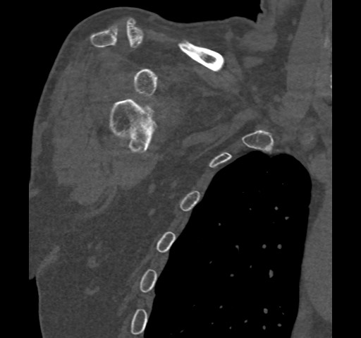 Anterior glenohumeral dislocation with Hill-Sachs lesion (Radiopaedia 62877-71249 Coronal bone window 15).jpg