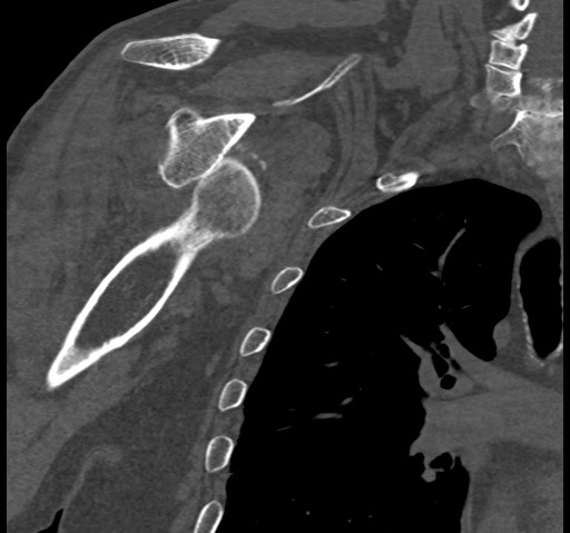 Anterior glenohumeral dislocation with Hill-Sachs lesion (Radiopaedia 62877-71249 Coronal bone window 57).jpg
