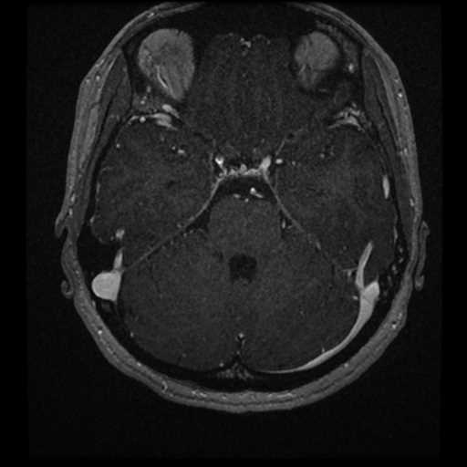 Anterior inferior cerebellar artery vascular loop - type II (Radiopaedia 70991-81209 Axial T1 C+ 16).jpg
