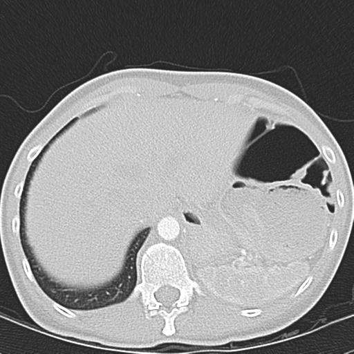 Anterior mediastinal lymphoma (Radiopaedia 29556-30061 Axial lung window 50).jpg