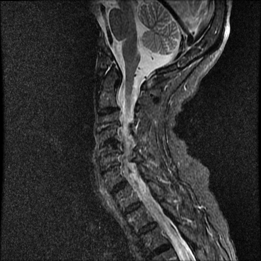 File:Anterior spinal artery syndrome (Radiopaedia 46335-50750 Sagittal STIR 5).png