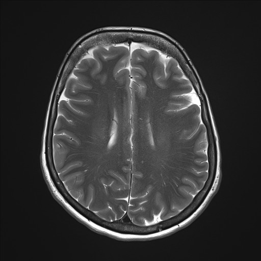 File:Anterior temporal encephalocele (Radiopaedia 82624-96808 Axial T2 25).jpg