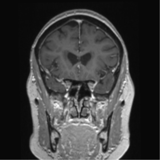 Anterior temporal pole cysts (Radiopaedia 46629-51102 Coronal T1 C+ 119).png