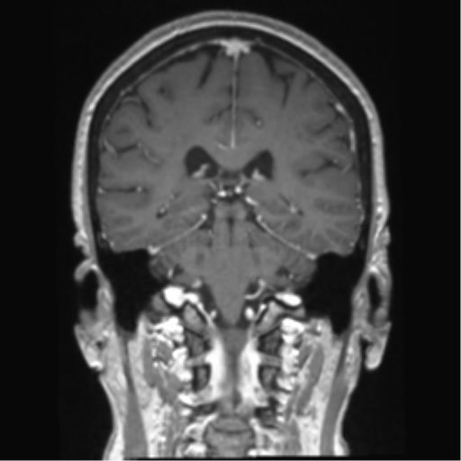 Anterior temporal pole cysts (Radiopaedia 46629-51102 Coronal T1 C+ 69).png