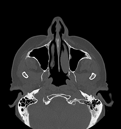 Anterior temporomandibular joint dislocation (Radiopaedia 59430-66784 Axial non-contrast 19).jpg