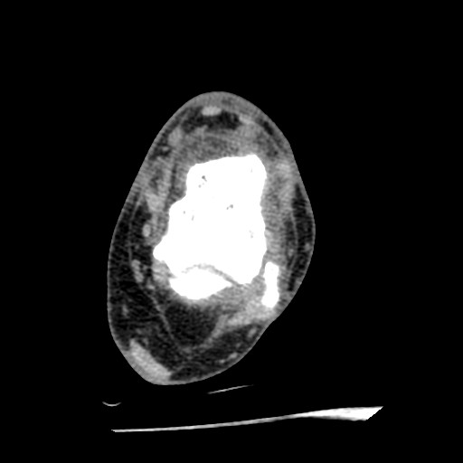 File:Anterior tibial artery false aneurysm (Radiopaedia 88984-105809 A 145).jpg