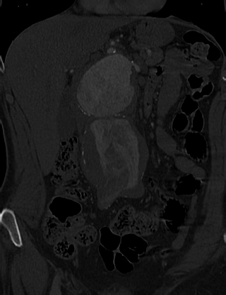 Anterior vertebral scalloping (abdominal aortic aneurysm) (Radiopaedia 66744-76067 Coronal bone window 4).jpg