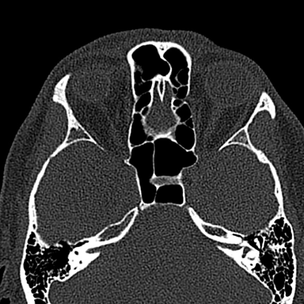 Antrochoanal polyp (Radiopaedia 30002-30554 Axial bone window 42).jpg