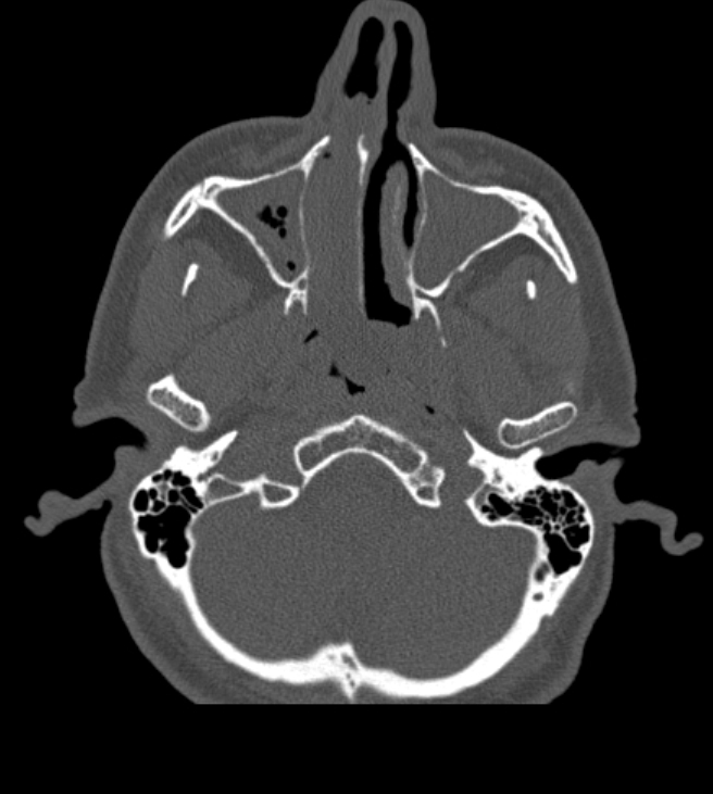 Antrochoanal polyp (Radiopaedia 79011-92169 Axial bone window 16).jpg