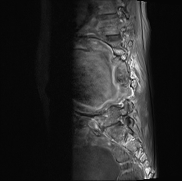 File:Aortic aneurysm with spinal destruction (Radiopaedia 42301-45409 Sagittal T1 fat sat 20).jpg