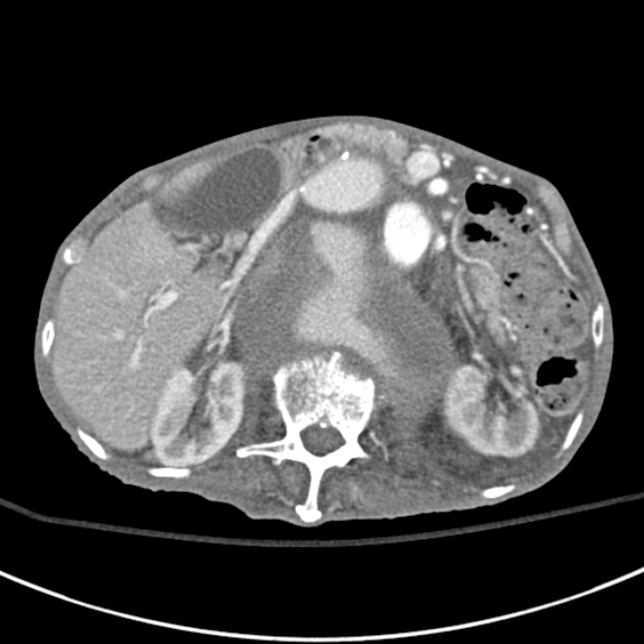 File:Aortic aneurysm with spinal destruction (Radiopaedia 42301-45410 A 33).jpg