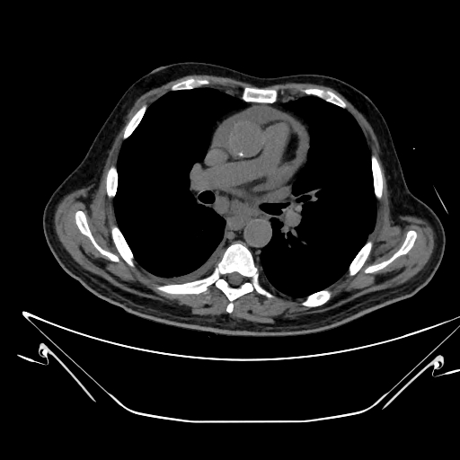 Aortic arch aneurysm (Radiopaedia 84109-99365 Axial non-contrast 134).jpg