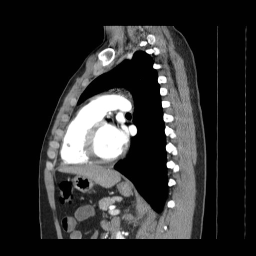 File:Aortic arch stent (Radiopaedia 30030-30595 E 17).jpg