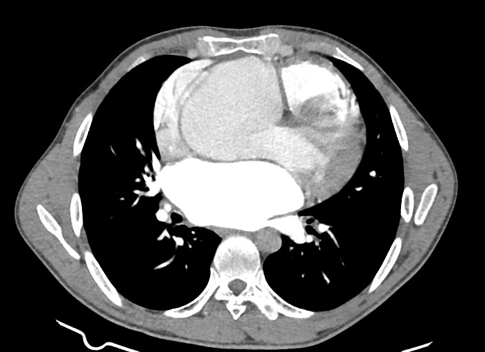 File:Aortic coarctation with aneurysm (Radiopaedia 74818-85828 A 102).jpg