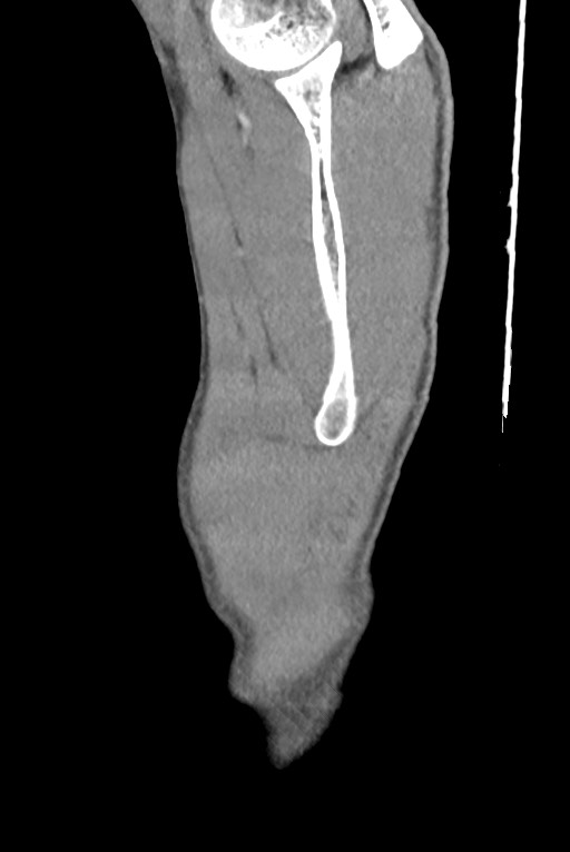 Aortic coarctation with aneurysm (Radiopaedia 74818-85828 B 10).jpg