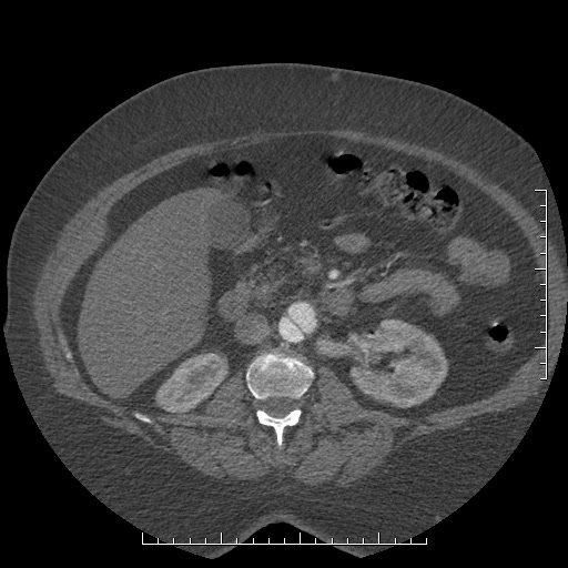 Aortic dissection- Stanford A (Radiopaedia 35729-37268 B 69).jpg