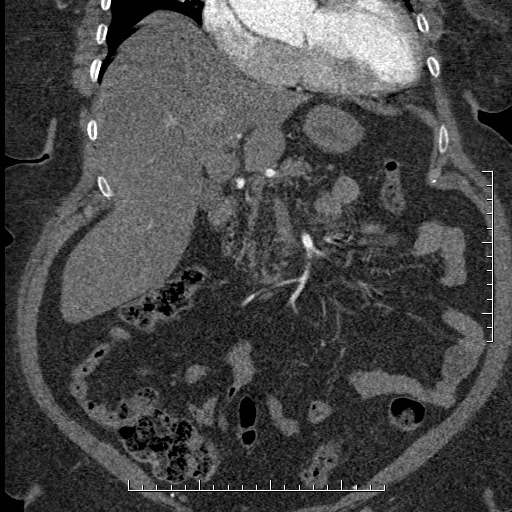 Aortic dissection- Stanford A (Radiopaedia 35729-37268 F 51).jpg
