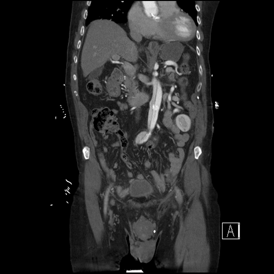 File:Aortic dissection (CTPA) (Radiopaedia 75506-86750 F 25).jpg