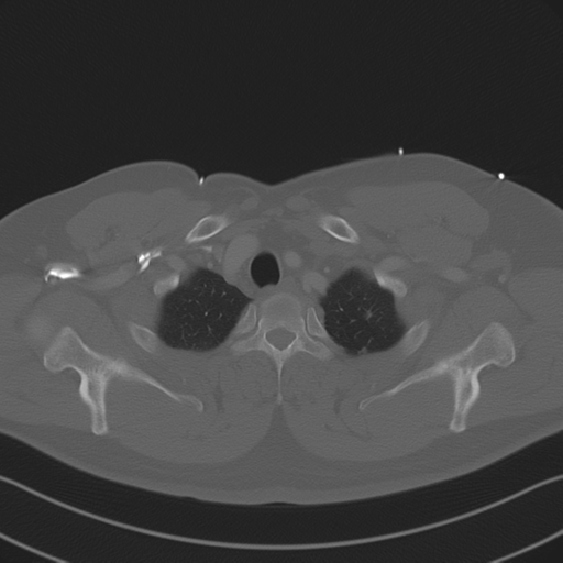 Aortic dissection (Radiopaedia 50763-56234 Axial bone window 18).png