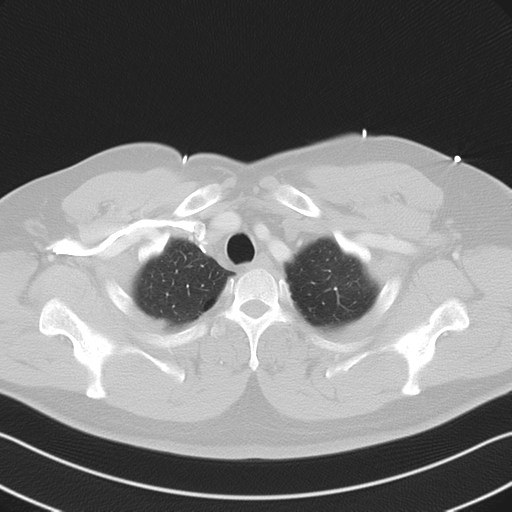 File:Aortic dissection (Radiopaedia 50763-56234 Axial lung window 14).png