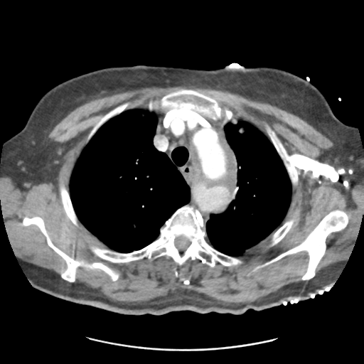 File:Aortic dissection - Stanford type B (Radiopaedia 50171-55512 A 11).png