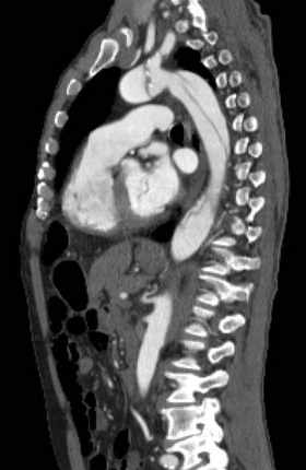 Aortic dissection - Stanford type B (Radiopaedia 73648-84437 C 66).jpg