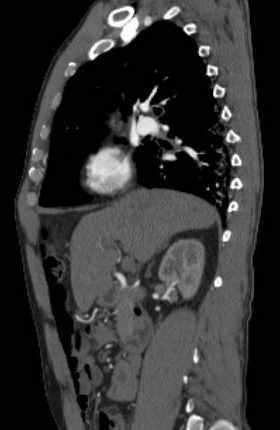 File:Aortic dissection - Stanford type B (Radiopaedia 73648-84437 C 99).jpg