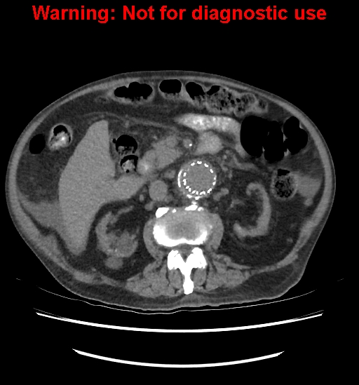 Aortic graft infection (Radiopaedia 44979-48907 Axial non-contrast 45).jpg